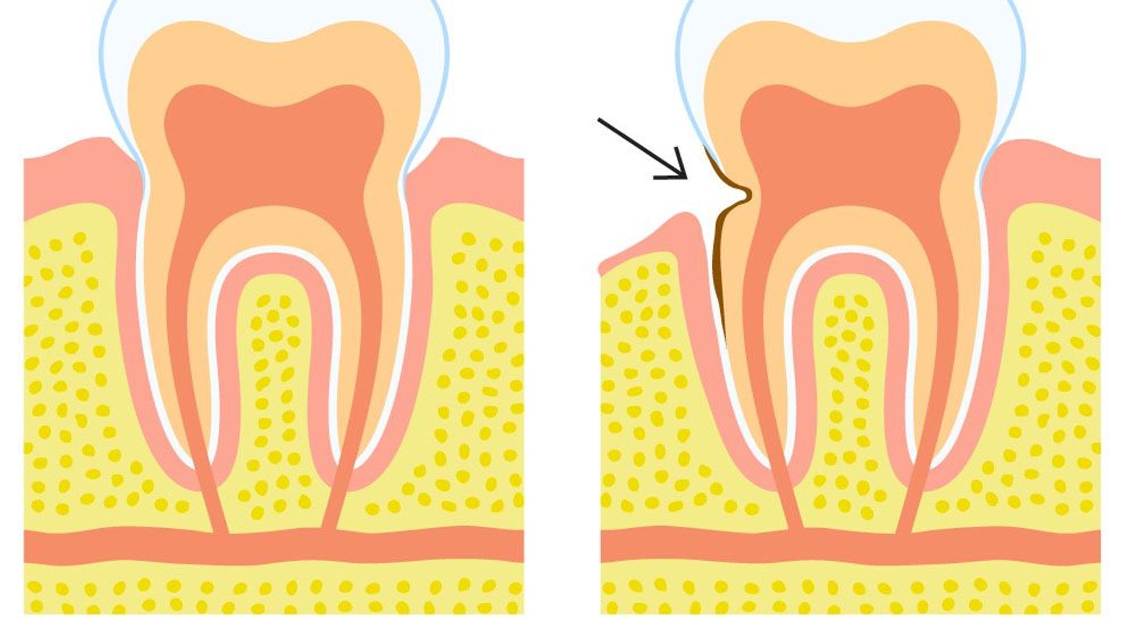 Dental Abfractions: What Are They and How Can You Protect Your Smile?