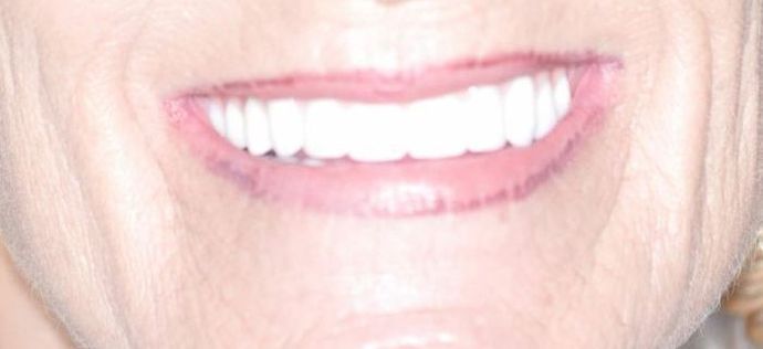Teeth in a Day: Case 16 — Upper and Lower Arch before