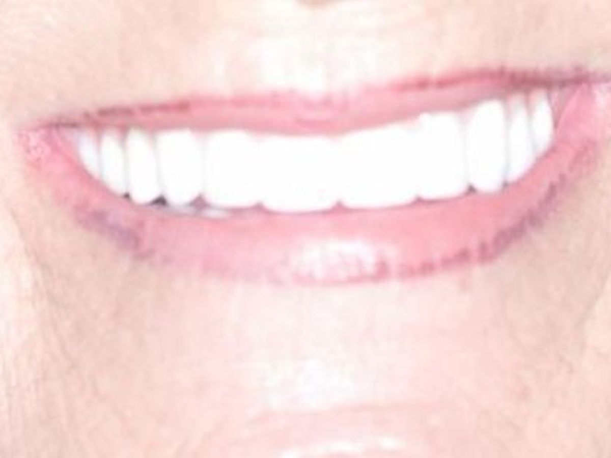 Teeth in a Day: Case 16 — Upper and Lower Arch before