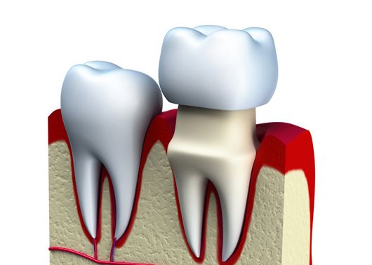 Heightened Sensitivity after Dental Crown Treatment