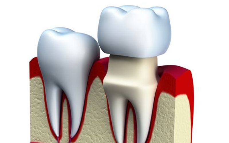 Heightened Sensitivity after Dental Crown Treatment