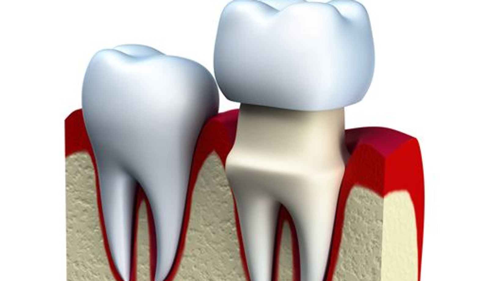 Heightened Sensitivity after Dental Crown Treatment