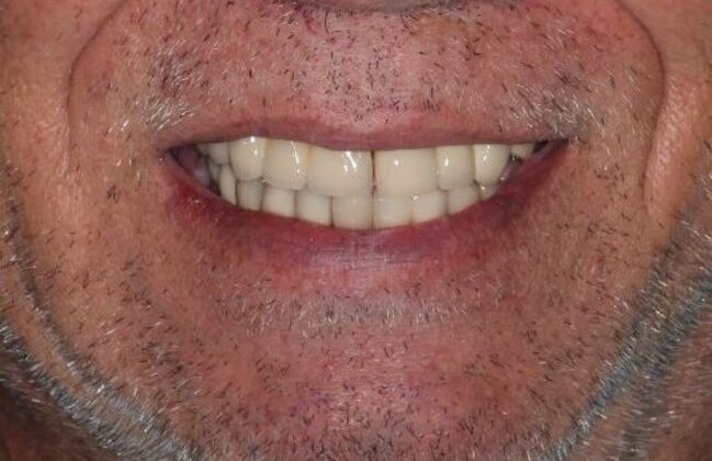 Dentures: Case 14 — Upper Overdenture before