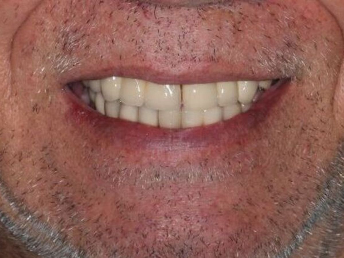 Dentures: Case 14 — Upper Overdenture before