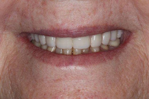Teeth in a Day: Case 1 — after