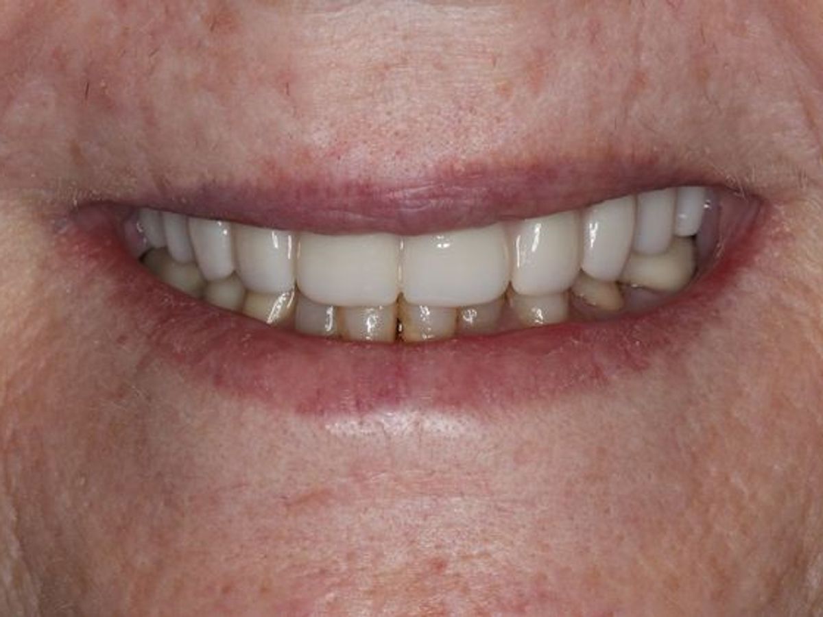 Teeth in a Day: Case 1 — after