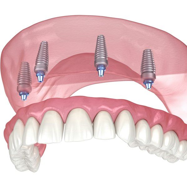 Implant-supported dentures