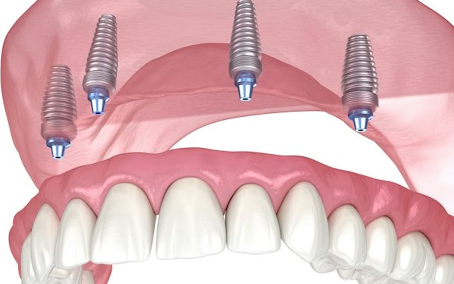 Implant-supported dentures