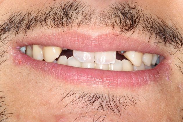 Dental Implants: Case 6 — before