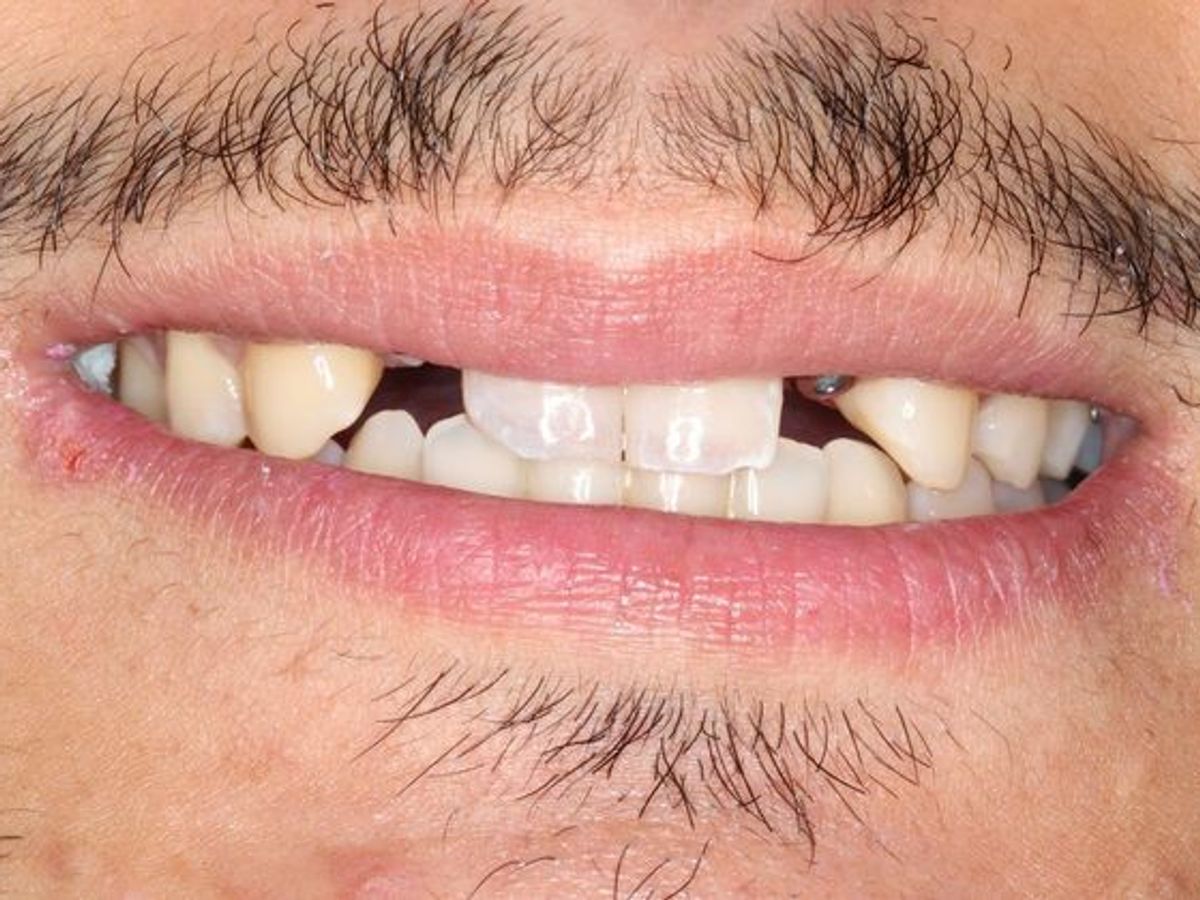 Dental Implants: Case 6 — before