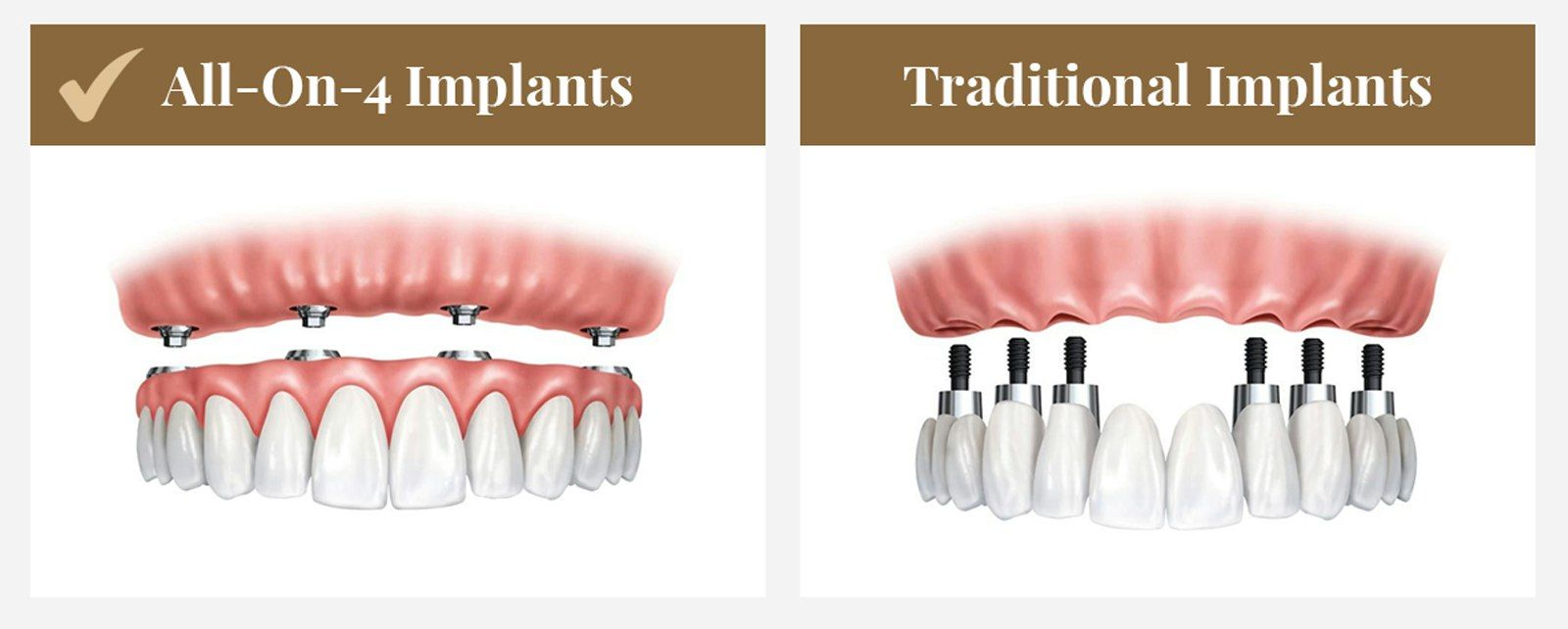 All-on-4 vs.traditional dental implants