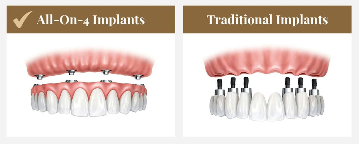 All-on-4 vs.traditional dental implants