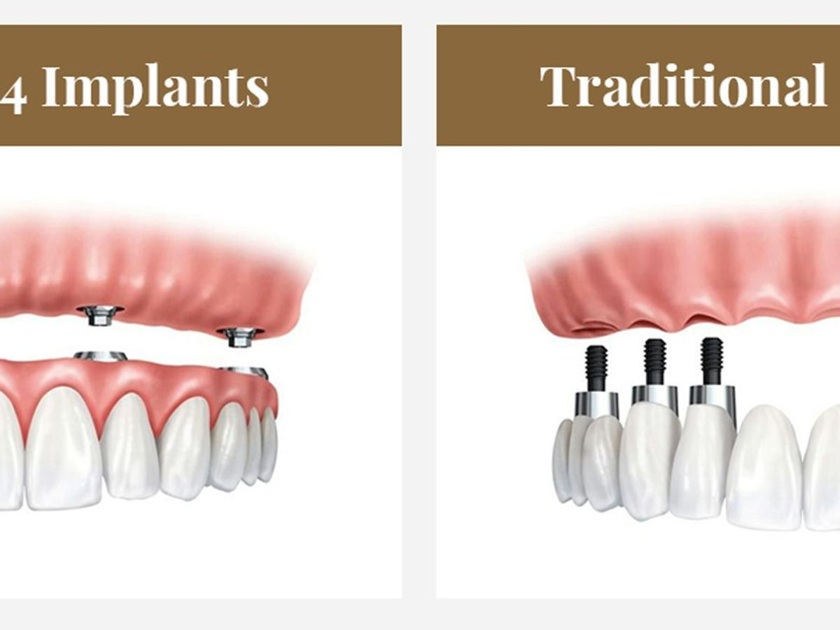 All-on-4 vs.traditional dental implants