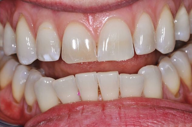 Veneers: Case 2 — before