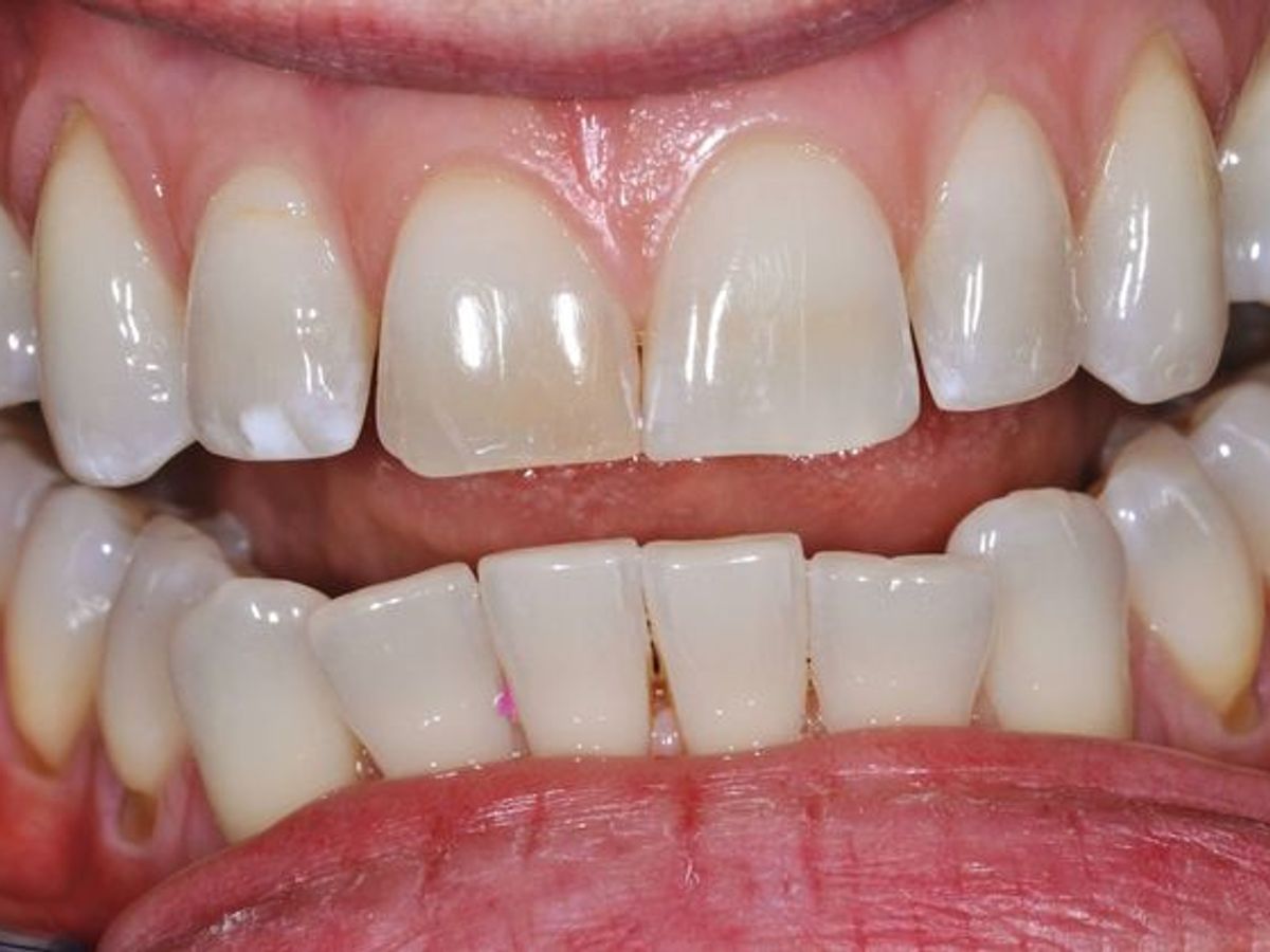 Veneers: Case 2 — before