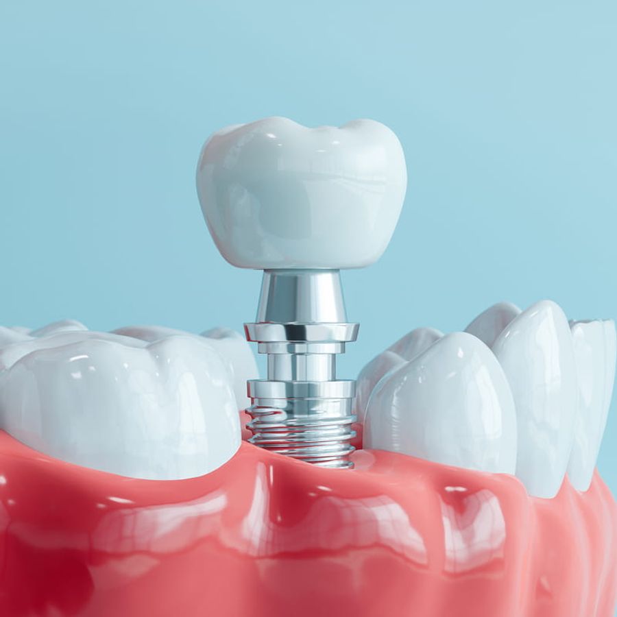 Dental Implants