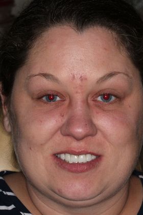 Dental Implants: Case 1 - after
