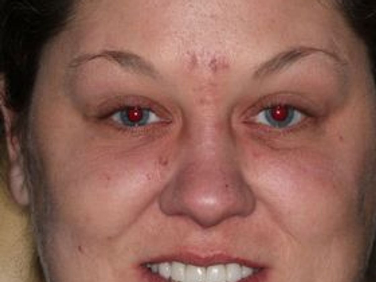 Dental Implants: Case 1 — after