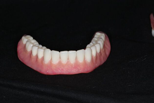 Dentures: Case 19 — before