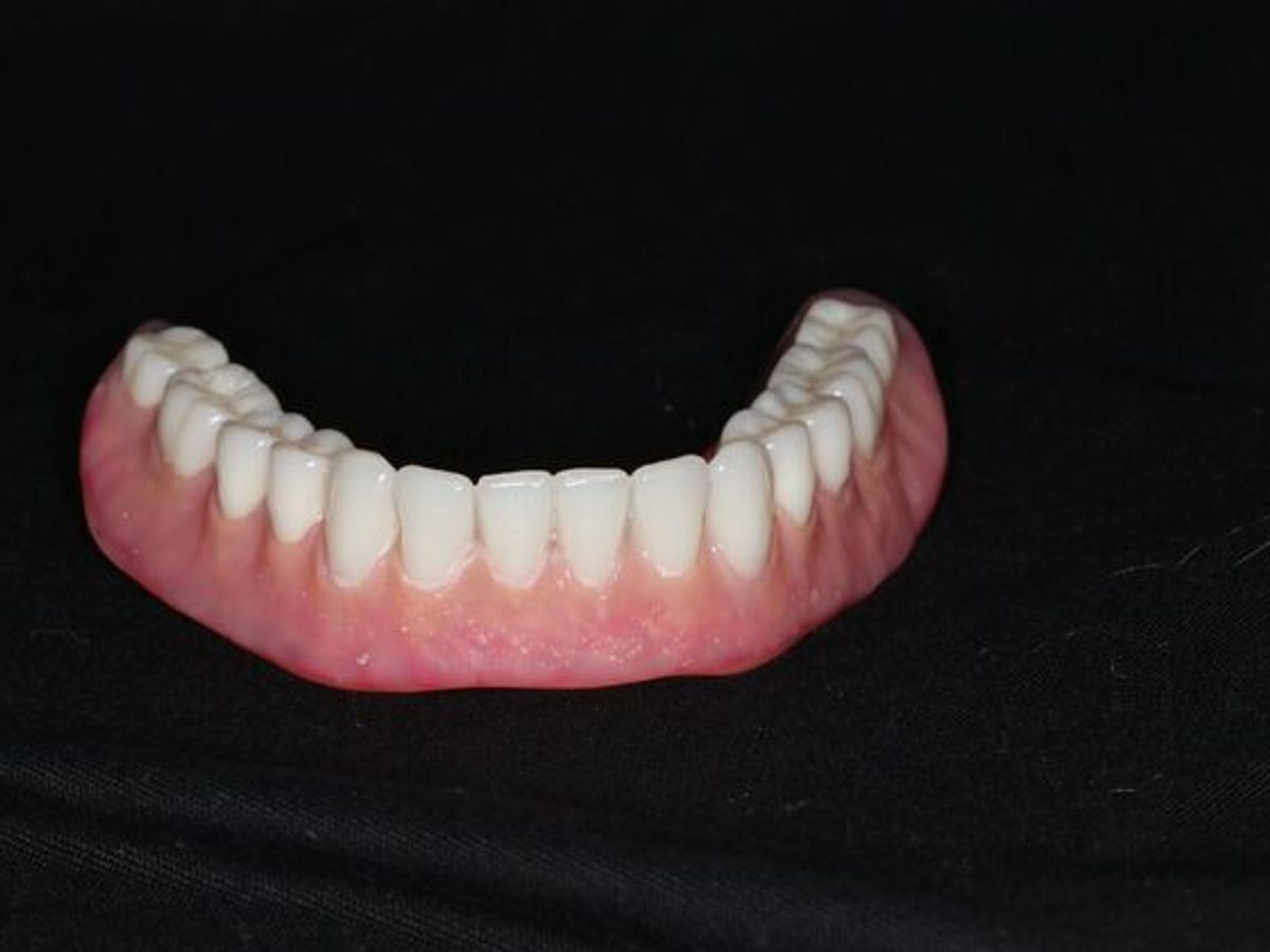 Dentures: Case 19 — before