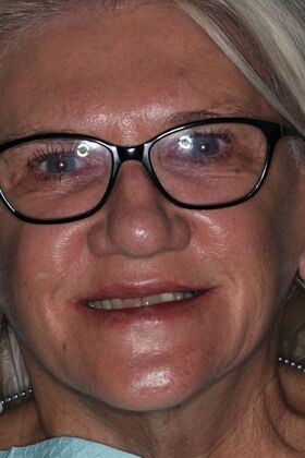 Dental Implants: Case 12 — before