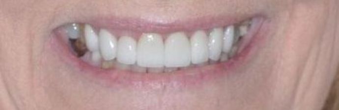 Dental Crowns: Case 13 — after
