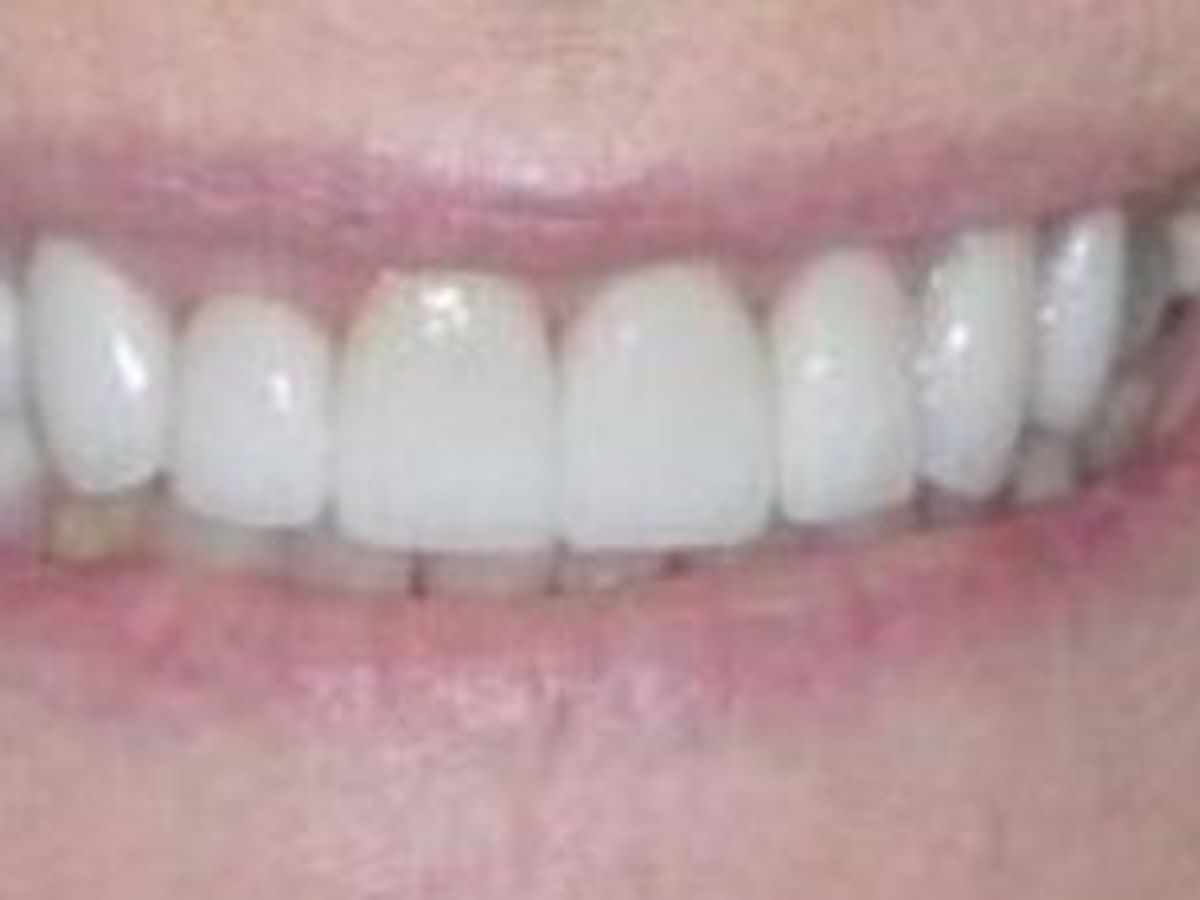 Dental Crowns: Case 13 — after