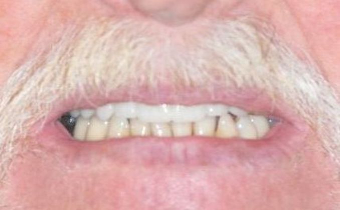 Dental Crowns: Case 27 — after