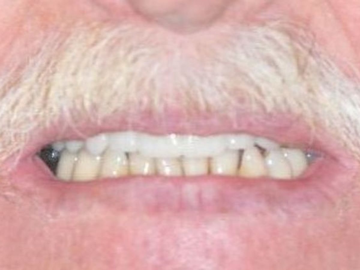 Dental Crowns: Case 27 — after