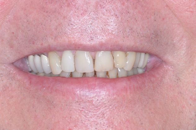 Dental Crowns: Case 6 — before