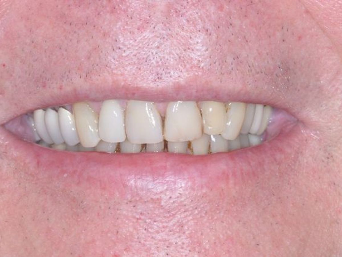 Dental Crowns: Case 6 — before