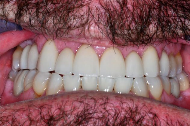 Dental Crowns: Case 15 — after