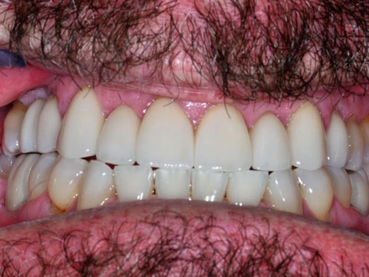 Dental Crowns: Case 15 — after