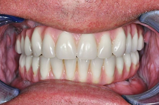 Teeth in a Day: Case 9 — Upper and Lower Arch / Upper Arch before
