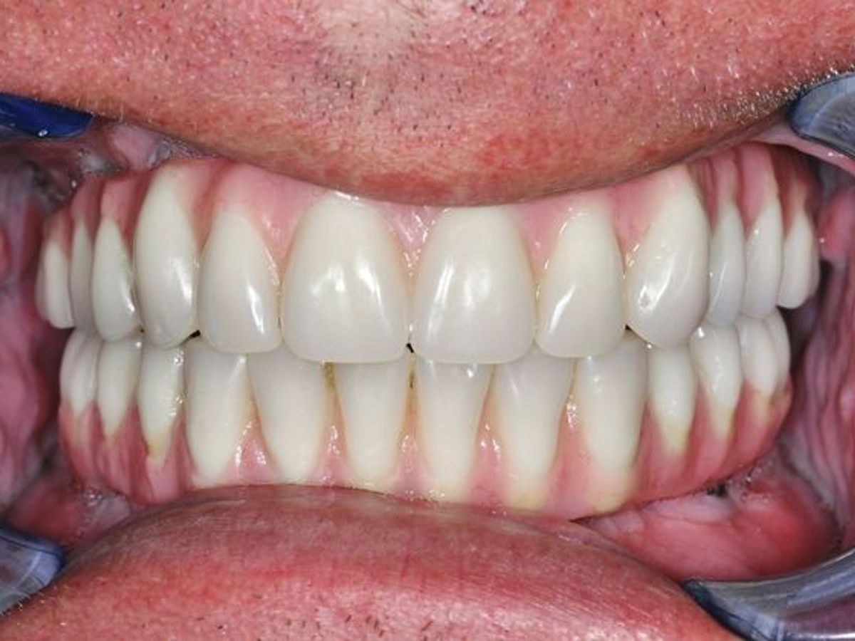 Teeth in a Day: Case 9 — Upper and Lower Arch / Upper Arch before