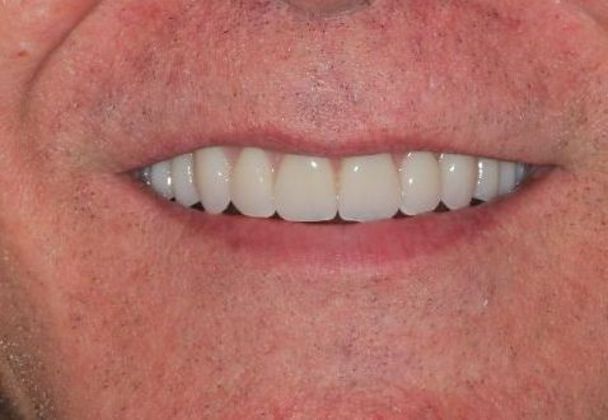 Dentures: Case 3 — after
