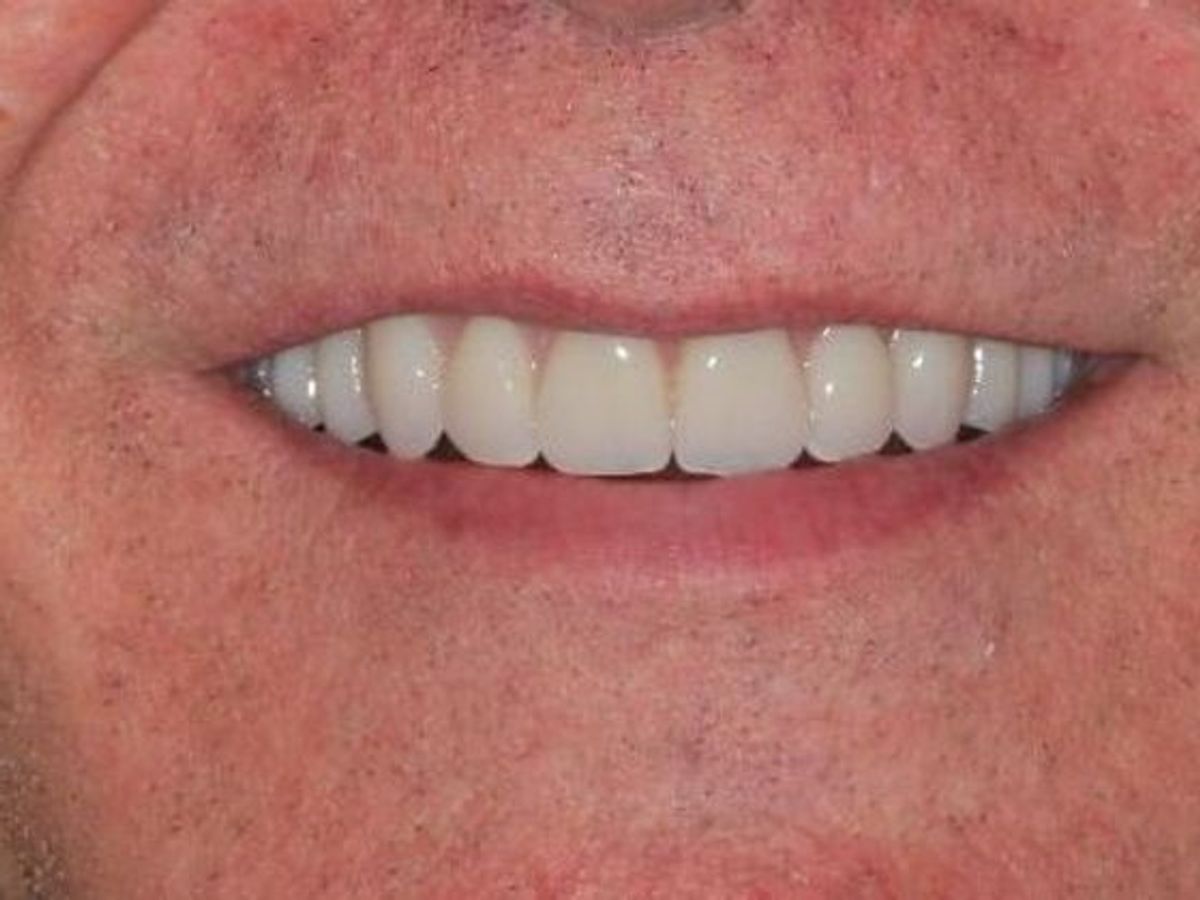Dentures: Case 3 — after
