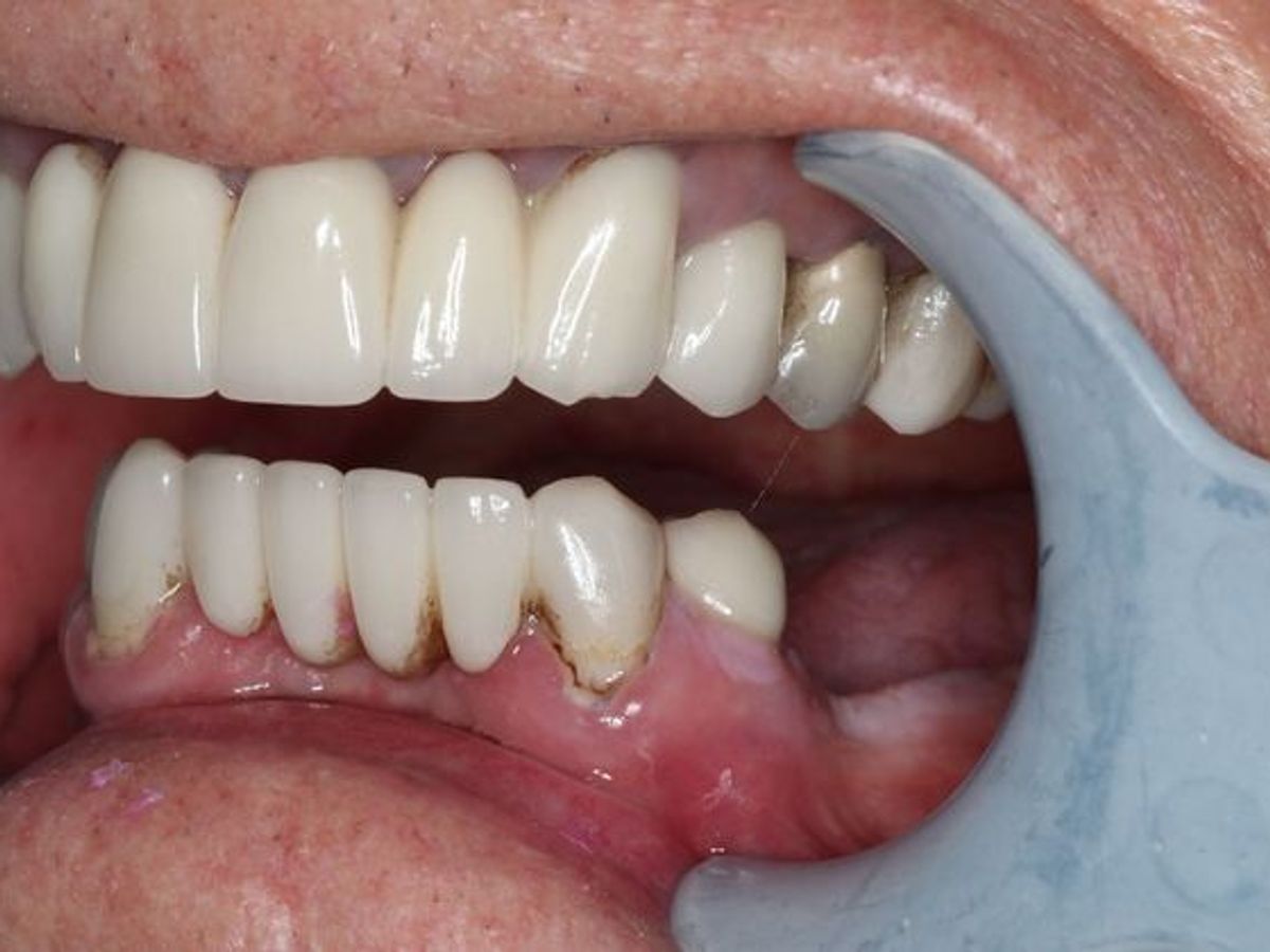 Teeth in a Day: Case 24 — before