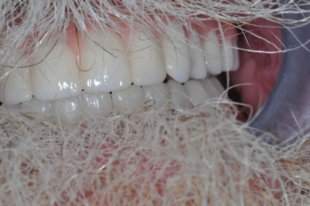 Teeth in a Day: Case 6 — after