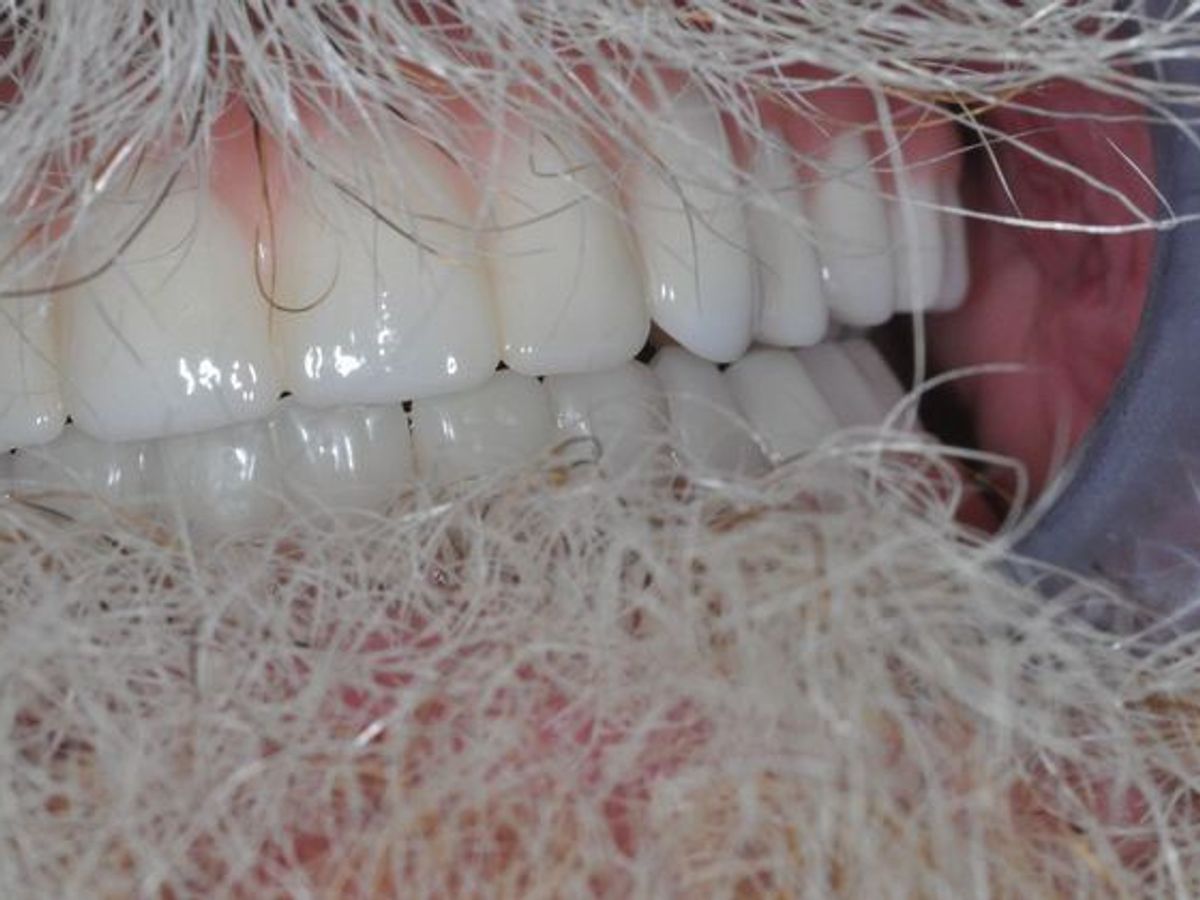 Teeth in a Day: Case 6 — after