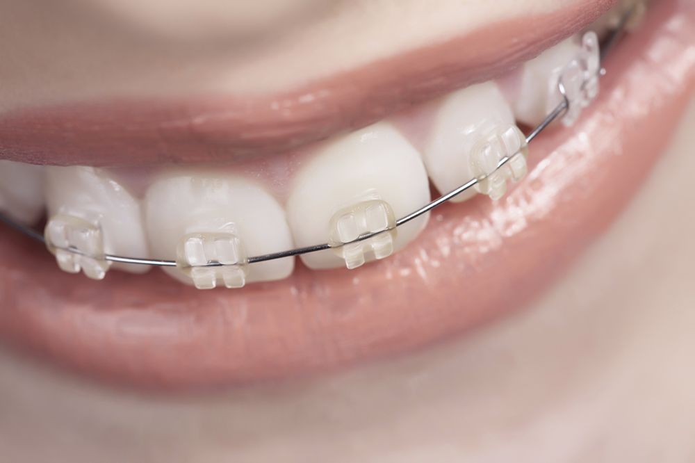 Best Toothbrush or Floss for Braces