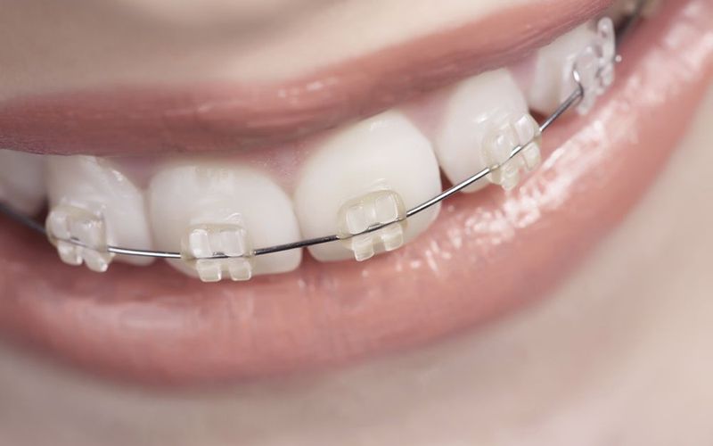 Best Toothbrush or Floss for Braces