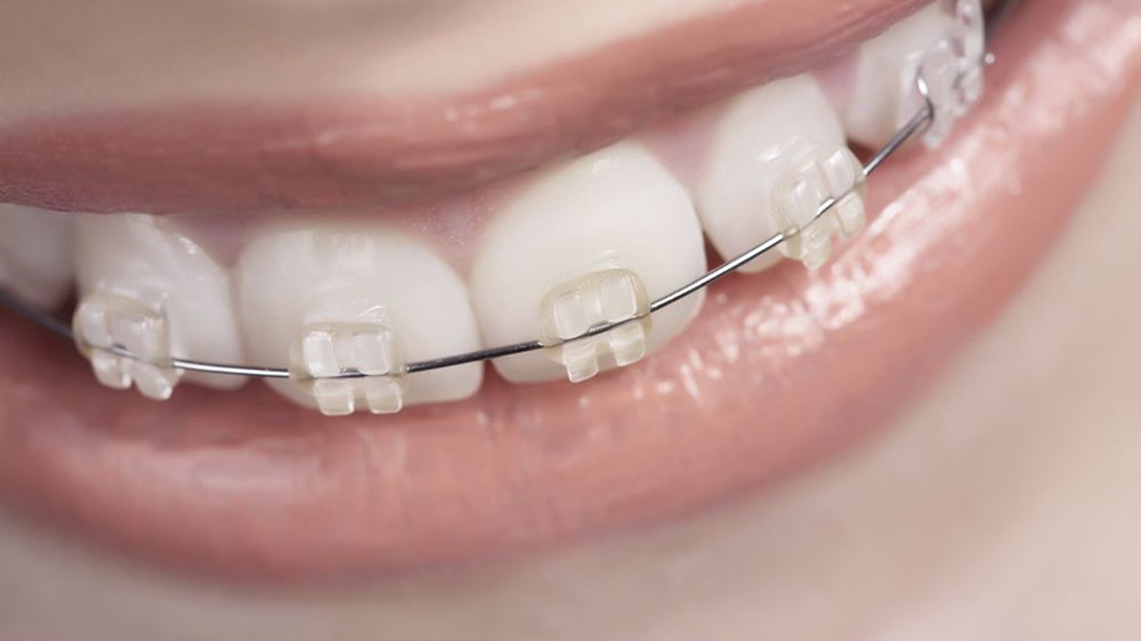 Best Toothbrush or Floss for Braces