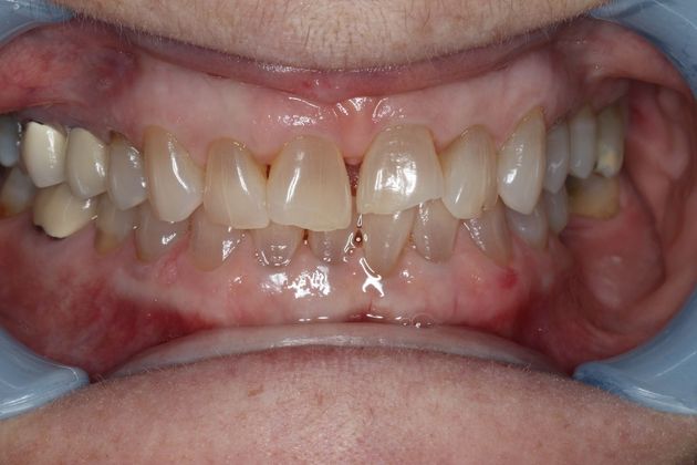 Veneers: Case 6 — before