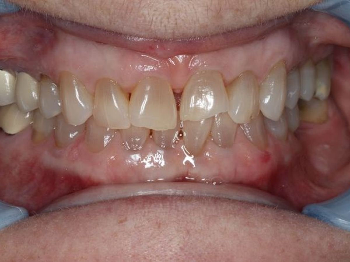 Veneers: Case 6 — before