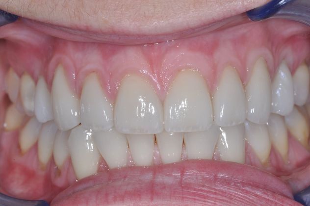 Veneers: Case 2 — after