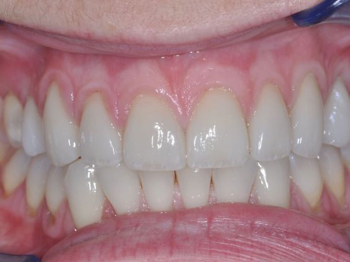 Veneers: Case 2 — after