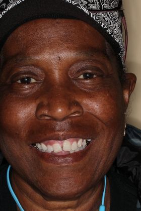 Veneers: Case 21 — before