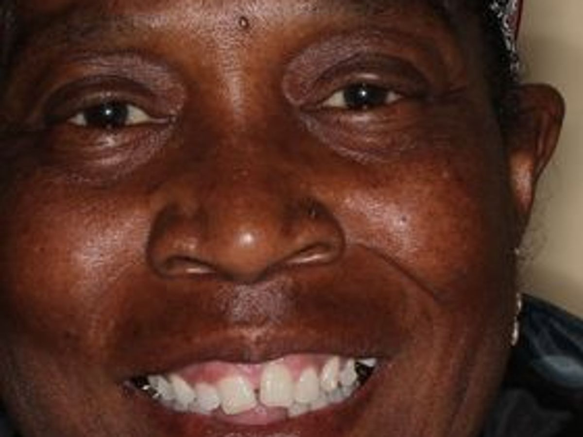 Veneers: Case 21 — before