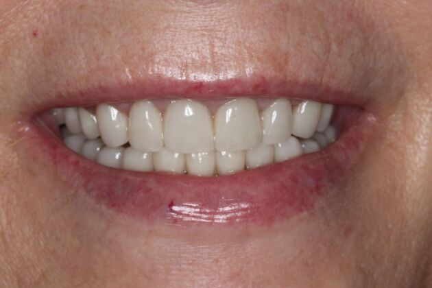 Veneers: Case 34 — after